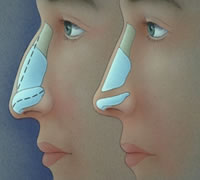 Feminizing Rhinoplasty